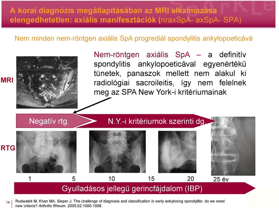 sacroileitis, így nem felelnek meg az SPA New York-i kritériumainak Negatív rtg. N.Y.-i kritériumok szerinti dg.