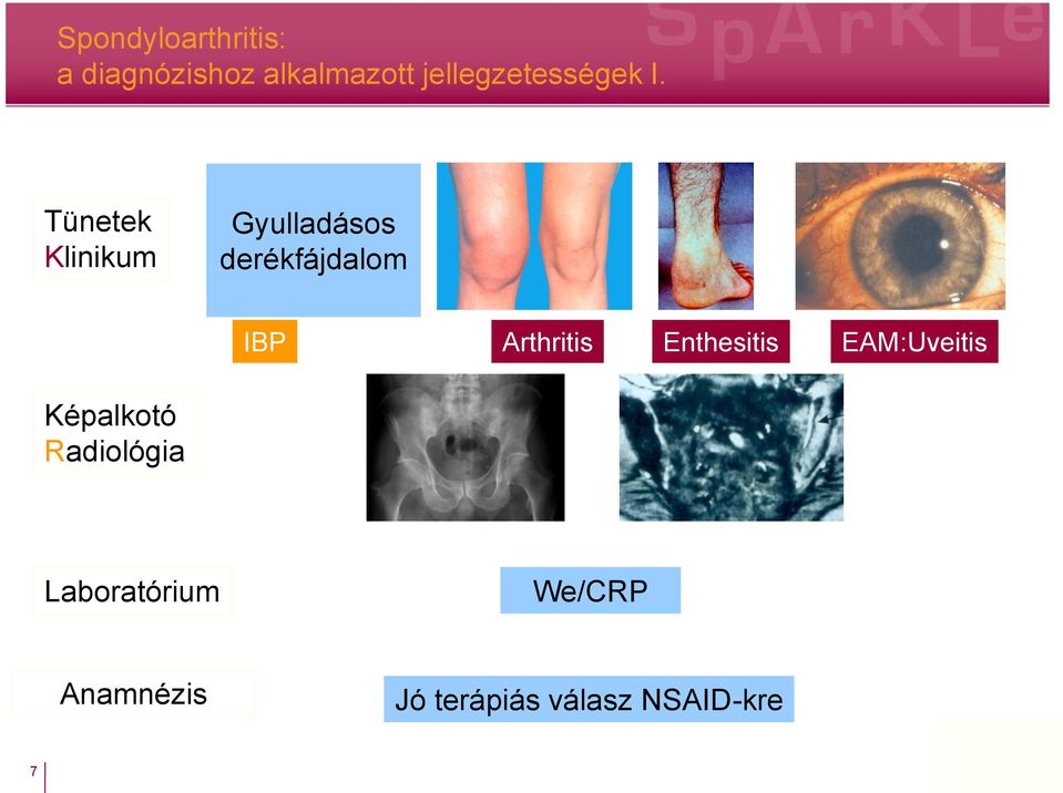 Tünetek Klinikum Gyulladásos derékfájdalom IBP Arthritis