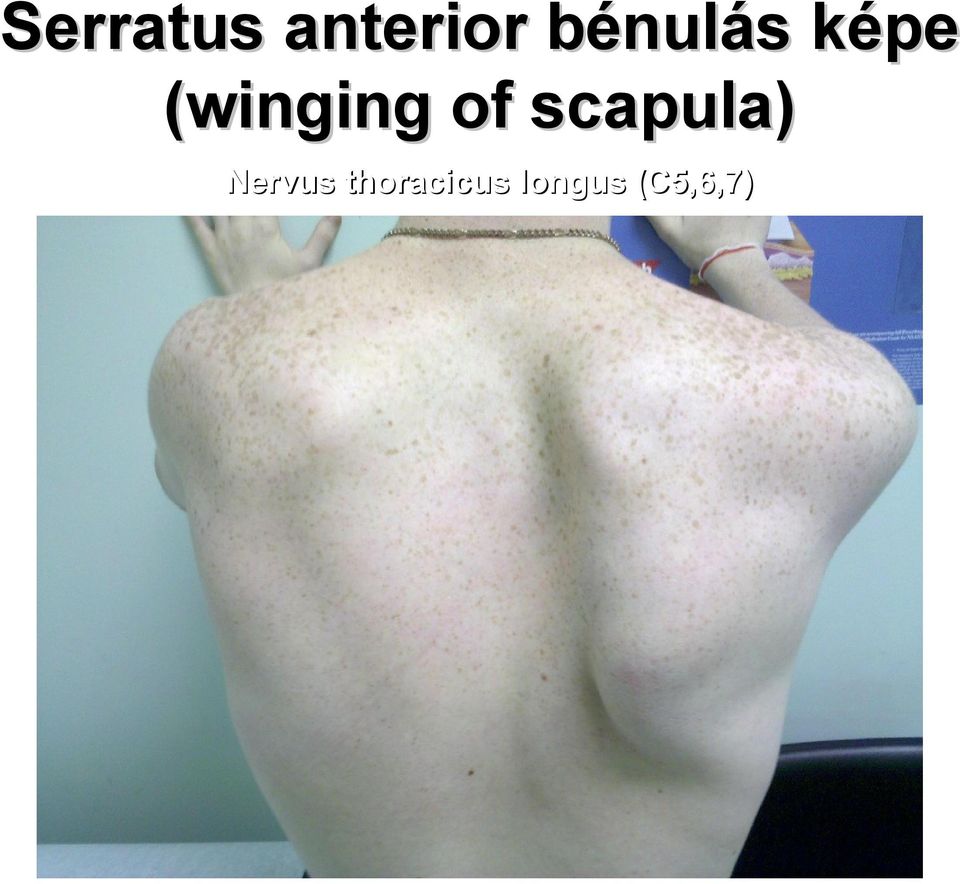 of scapula) Nervus