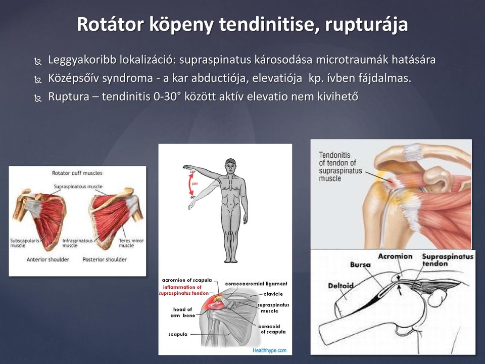 Középsőív syndroma - a kar abductiója, elevatiója kp.