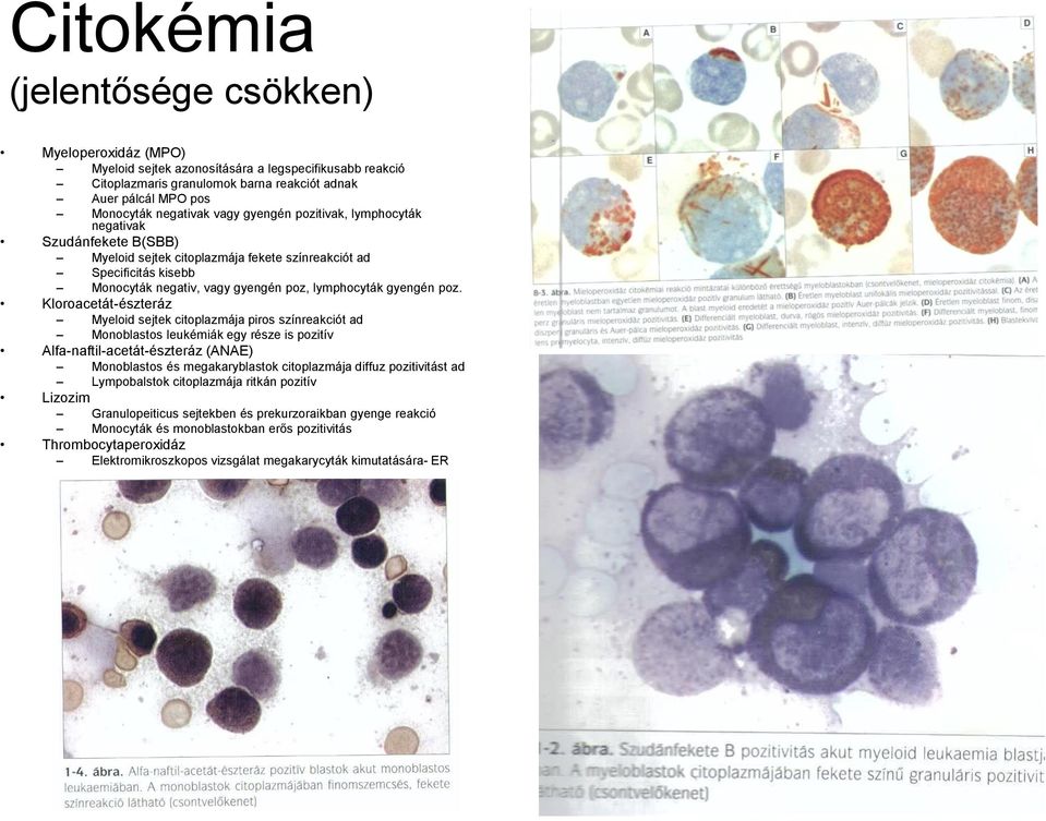 Kloroacetát-észteráz Myeloid sejtek citoplazmája piros színreakciót ad Monoblastos leukémiák egy része is pozitív Alfa-naftil-acetát-észteráz (ANAE) Monoblastos és megakaryblastok citoplazmája diffuz