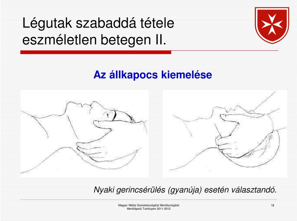 Az állkapocs kiemelése Nyaki