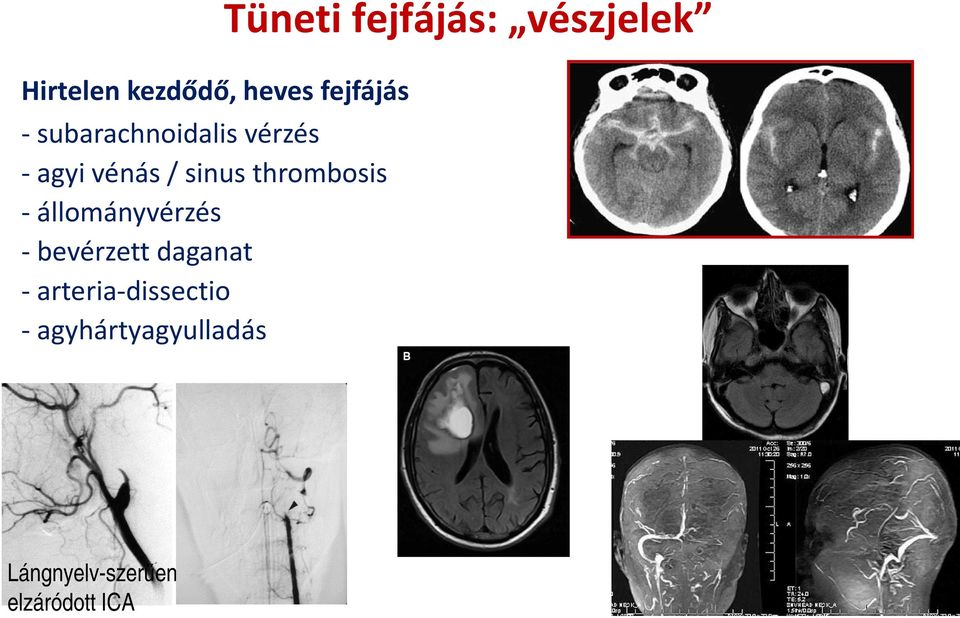 bevérzett daganat - arteria-dissectio -