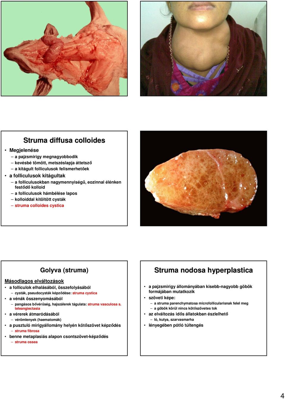 összefolyásából cysták, pseudocysták képzıdése: struma cystica a vénák összenyomásából pangásos bıvérőség, hajszálerek tágulata: struma vasculosa s.