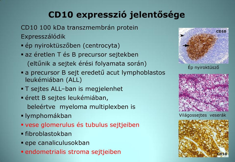 sejtes ALL ban is megjelenhet érett B sejtes leukémiában, beleértve myeloma multiplexben is lymphomákban vese glomerulus és