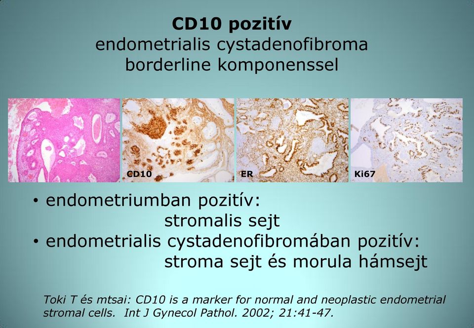 pozitív: stroma sejt és morula hámsejt Toki T és mtsai: CD10 is a marker for