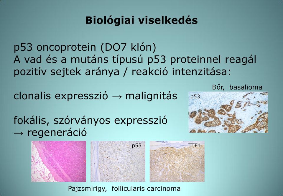 intenzitása: clonalis expresszió malignitás fokális, szórványos