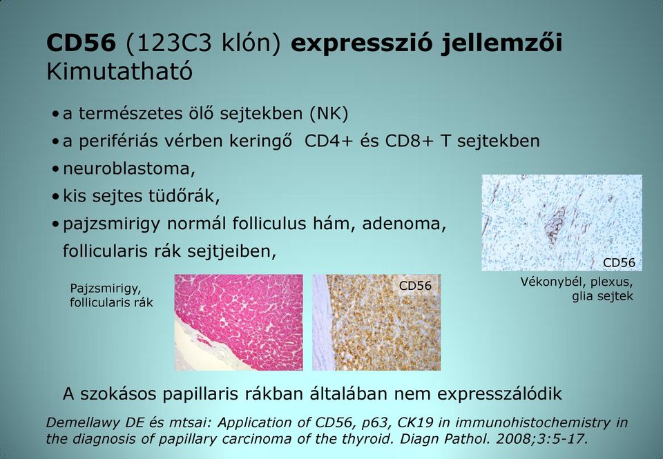 follicularis rák CD56 CD56 Vékonybél, plexus, glia sejtek A szokásos papillaris rákban általában nem expresszálódik Demellawy DE és