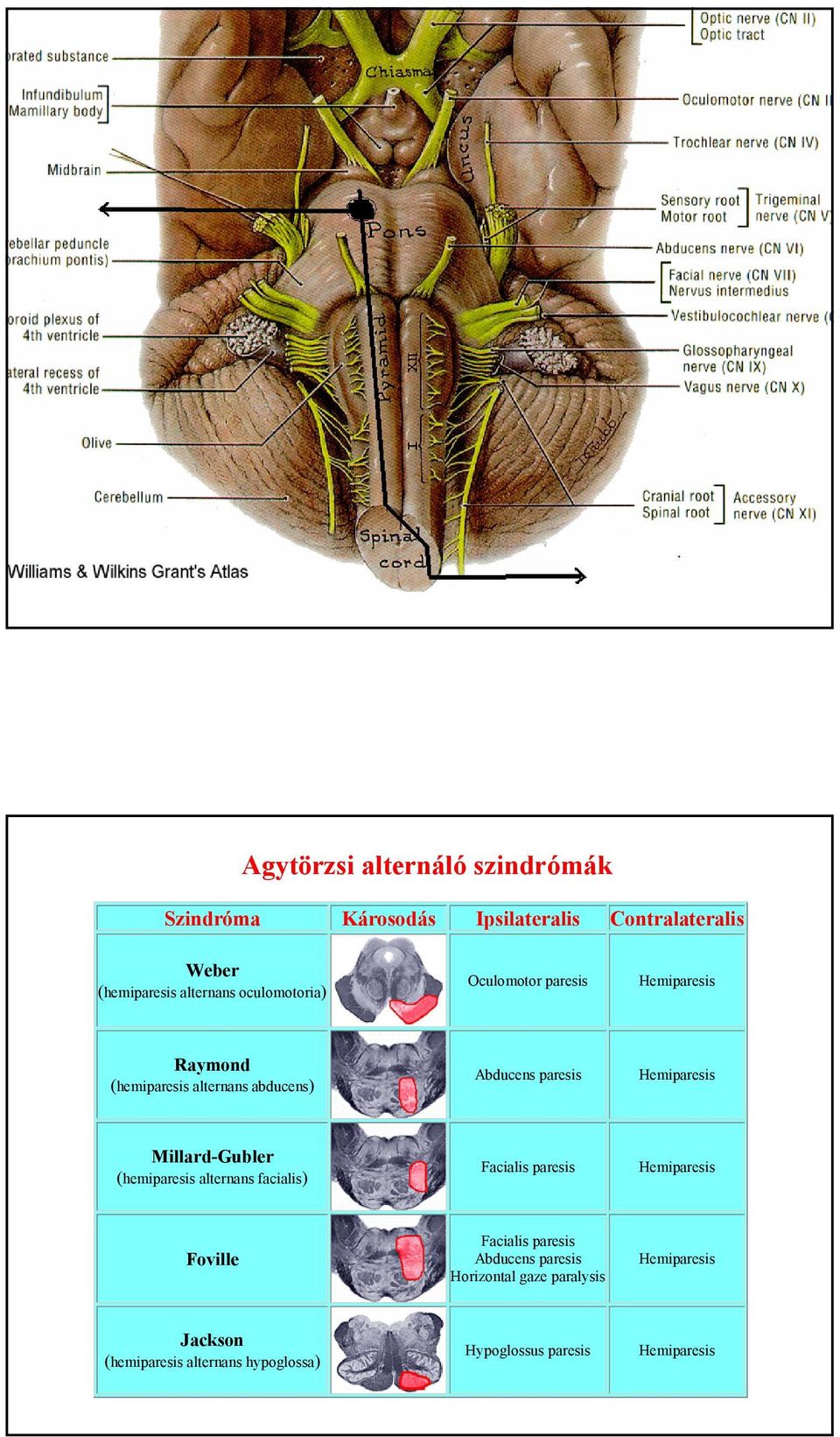 Hemiparesis Millard-Gubler (hemiparesis alternans facialis) Facialis paresis Hemiparesis Foville Facialis paresis