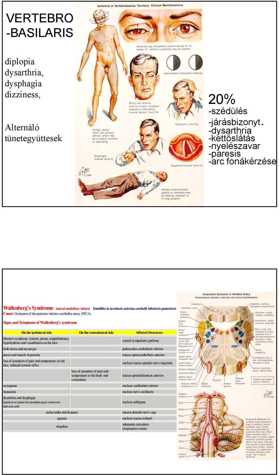 of the posterior inferior cerebellar artery (PICA) Signs and Symptoms of Wallenberg's syndrome On the ipsilateral side On the contralateral side Affected Structures Horner's syndrome, (miosis,