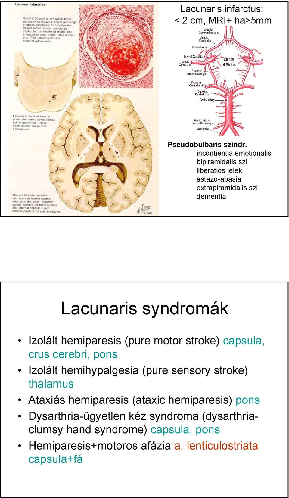 Izolált hemiparesis (pure motor stroke) capsula, crus cerebri, pons Izolált hemihypalgesia (pure sensory stroke) thalamus