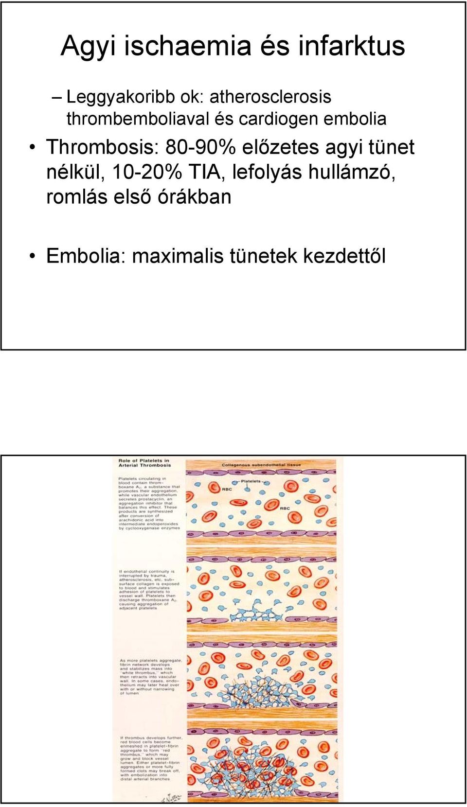 Thrombosis: 80-90% előzetes agyi tünet nélkül, 10-20% TIA,