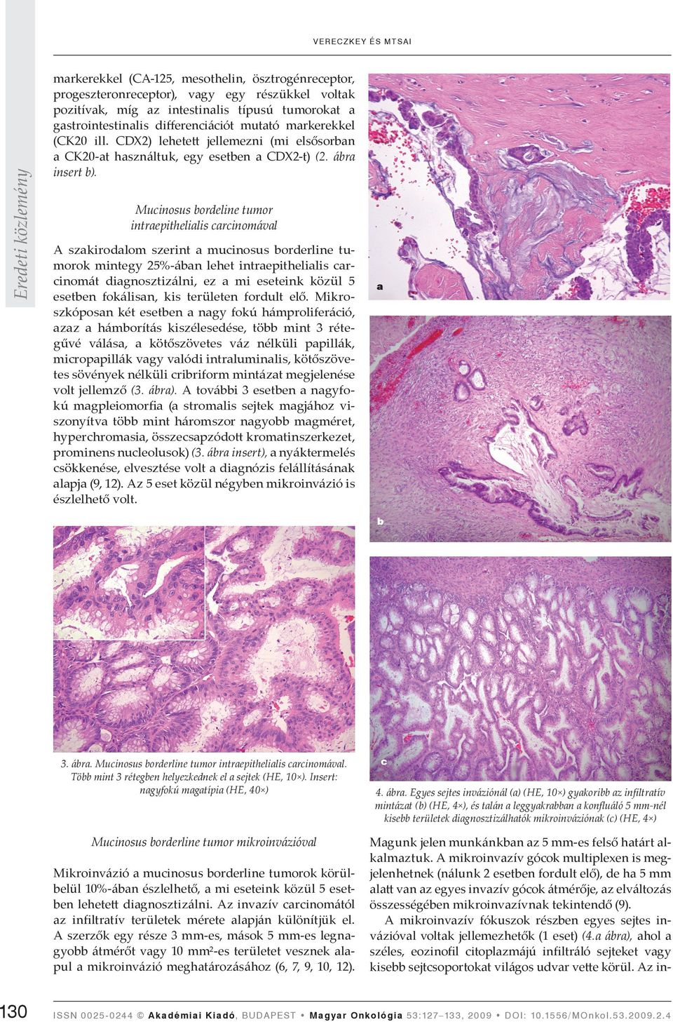Mucinosus bordeline tumor intraepithelialis carcinomával A szakirodalom szerint a mucinosus borderline tumorok mintegy 25%-ában lehet intraepithelialis carcinomát diagnosztizálni, ez a mi eseteink