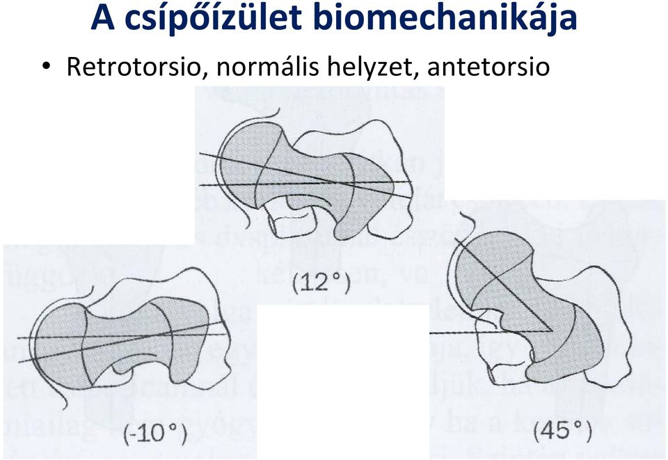 Retrotorsio,