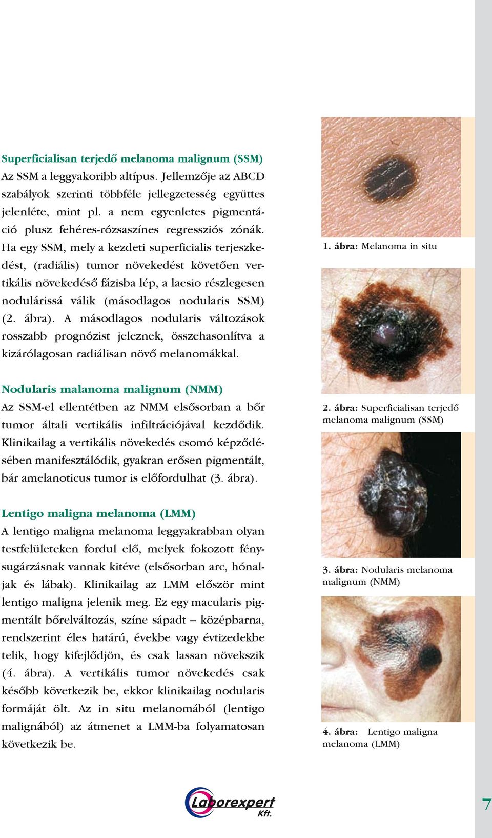 Ha egy SSM, mely a kezdeti superficialis terjeszkedést, (radiális) tumor növekedést követôen vertikális növekedésô fázisba lép, a laesio részlegesen nodulárissá válik (másodlagos nodularis SSM) (2.