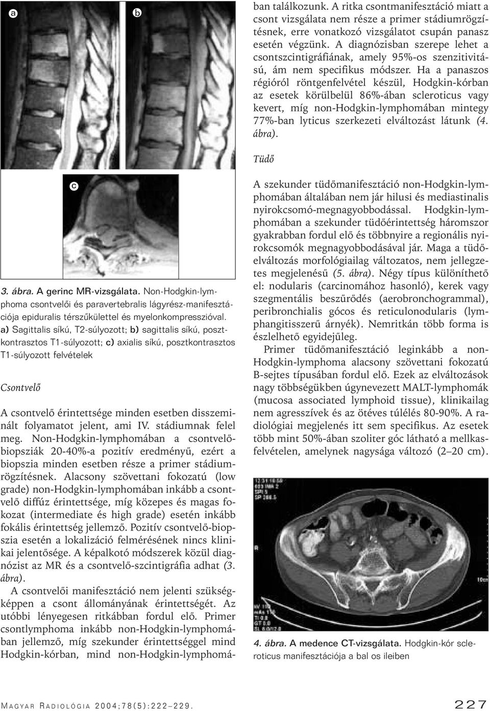 Alacsony szövettani fokozatú (low grade) non-hodgkin-lymphomában inkább a csontvelô diffúz érintettsége, míg közepes és magas fokozat (intermediate és high grade) esetén inkább fokális érintettség