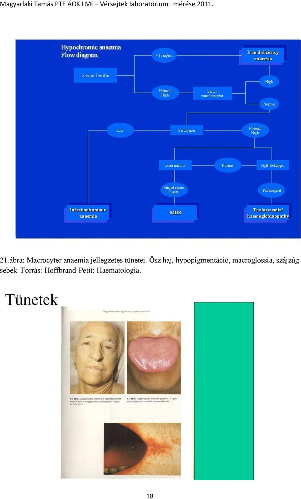 Ösz haj, hypopigmentáció,