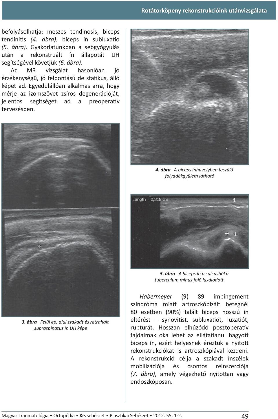 Egyedülállóan alkalmas arra, hogy mérje az izomszövet zsíros degenerációját, jelentős segítséget ad a preopera v tervezésben. 4. ábra A biceps ínhüvelyben feszülő folyadékgyülem látható 5.