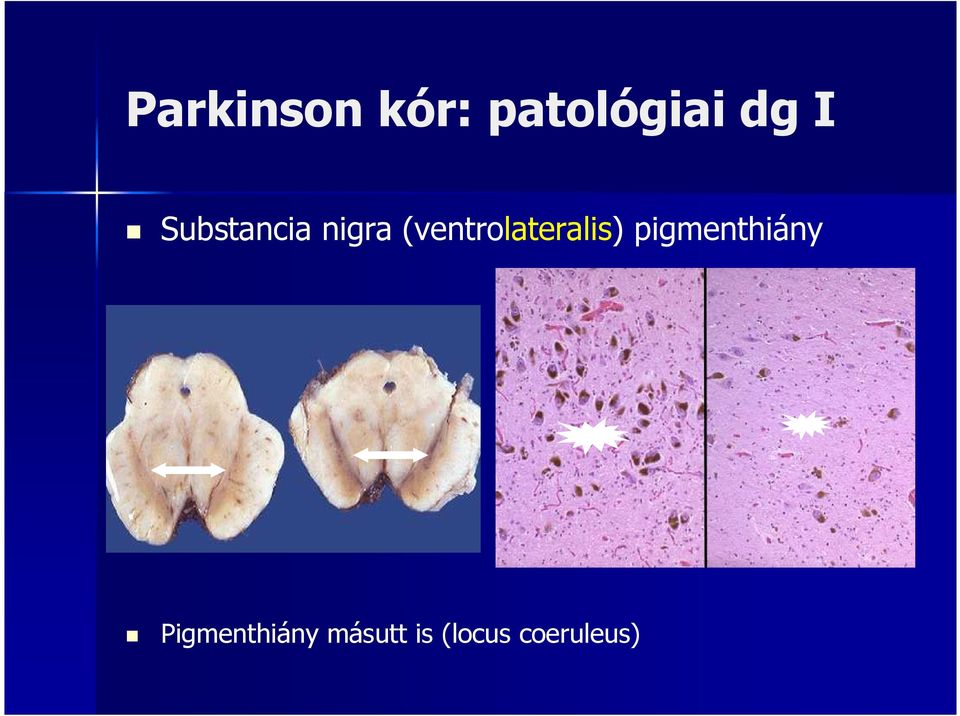 (ventrolateralis)