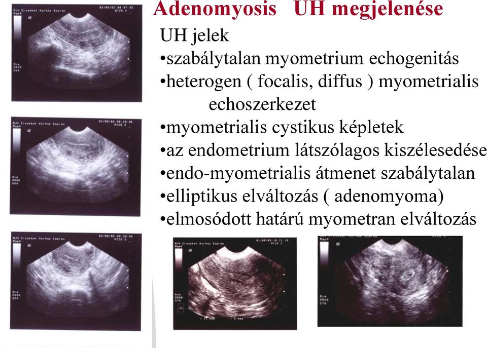 képletek az endometrium látszólagos kiszélesedése endo-myometrialis átmenet