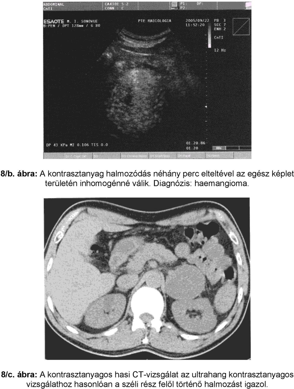 8/c. ábra: A kontrasztanyagos hasi CT-vizsgálat az ultrahang