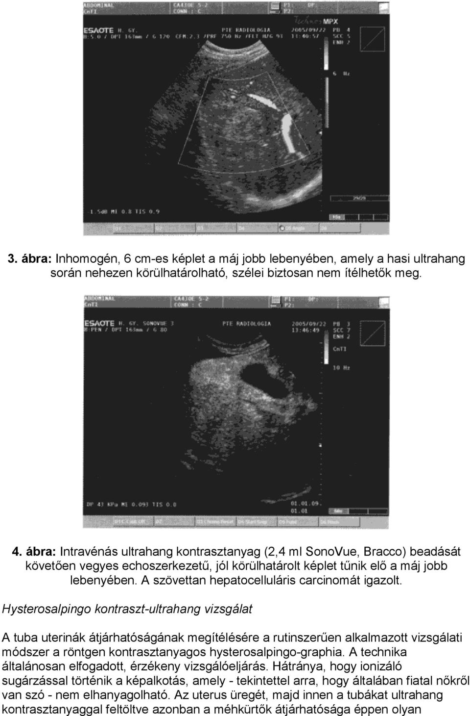 A szövettan hepatocelluláris carcinomát igazolt.