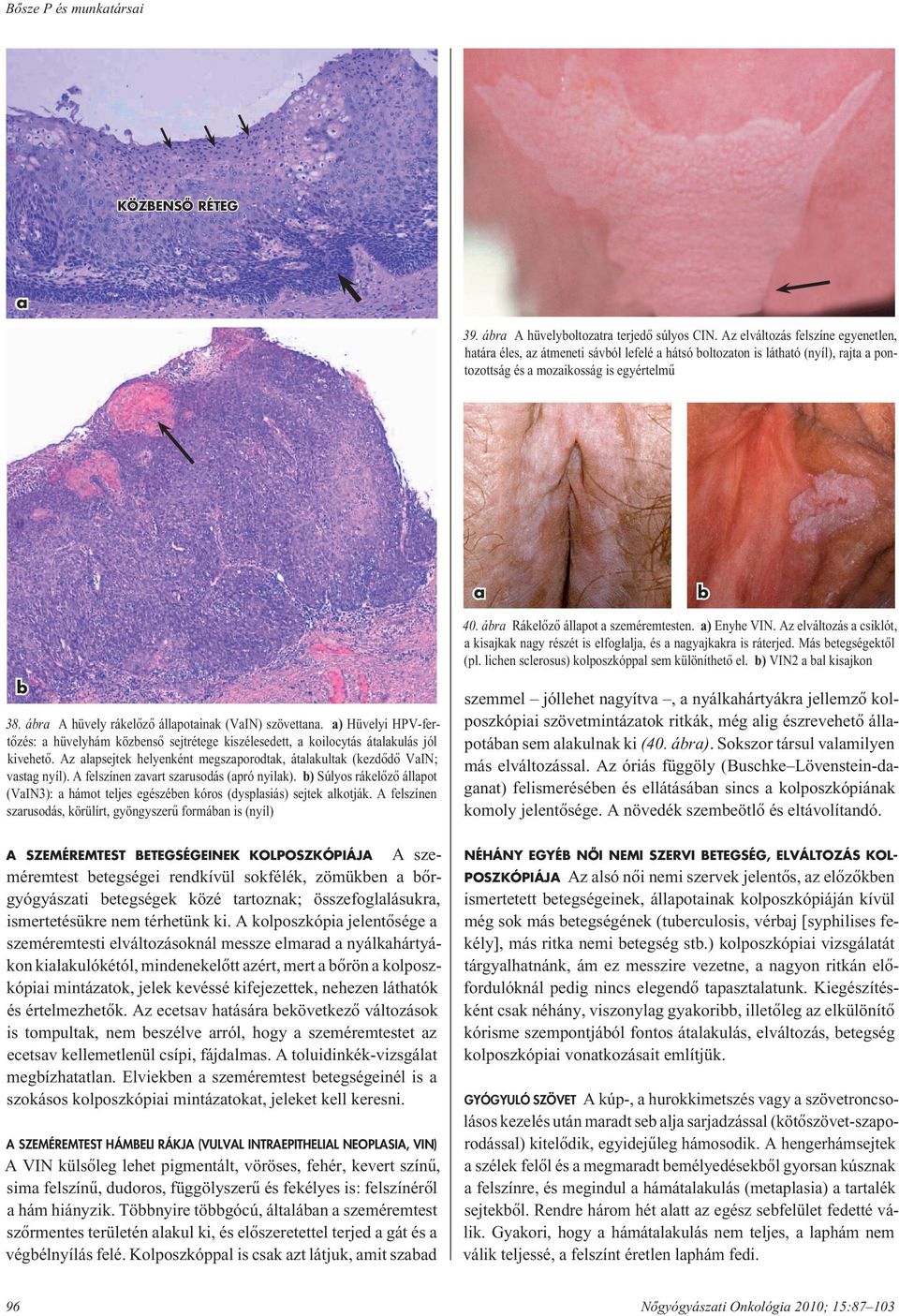 ábra A hüvely rákelôzô állapotainak (VaIN) szövettana. a) Hüvelyi HPV-fertô zés: a hüvelyhám közbensô sejtrétege kiszélesedett, a koilocytás átalakulás jól kive he tô.