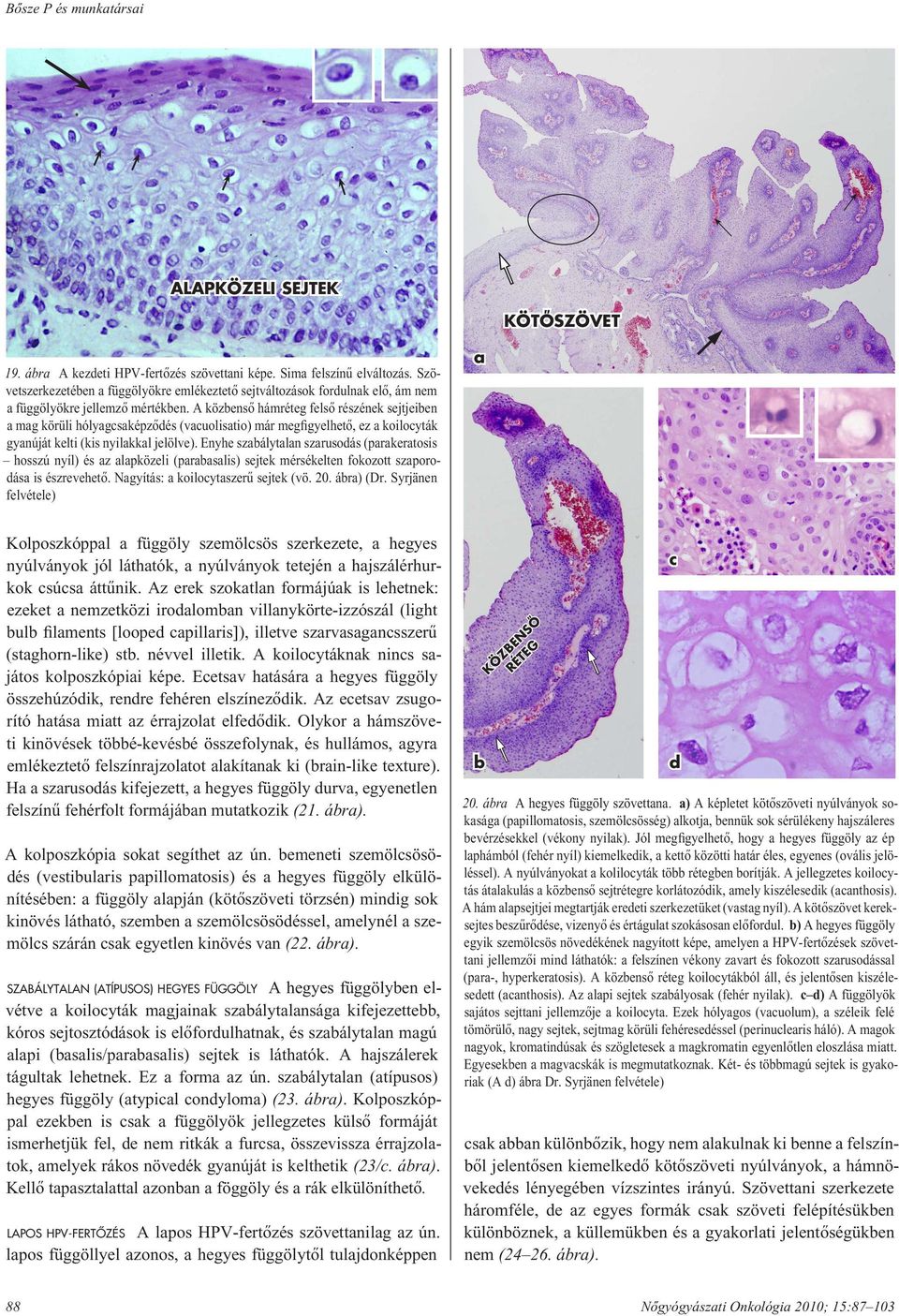 A közbensô hámréteg felsô részének sejtjeiben a mag körüli hólyagcsaképzôdés (vacuolisatio) már megfigyelhetô, ez a koilocyták gyanúját kelti (kis nyilakkal jelölve).