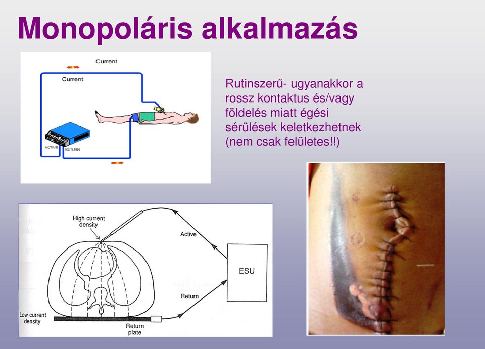 és/vagy földelés miatt égési