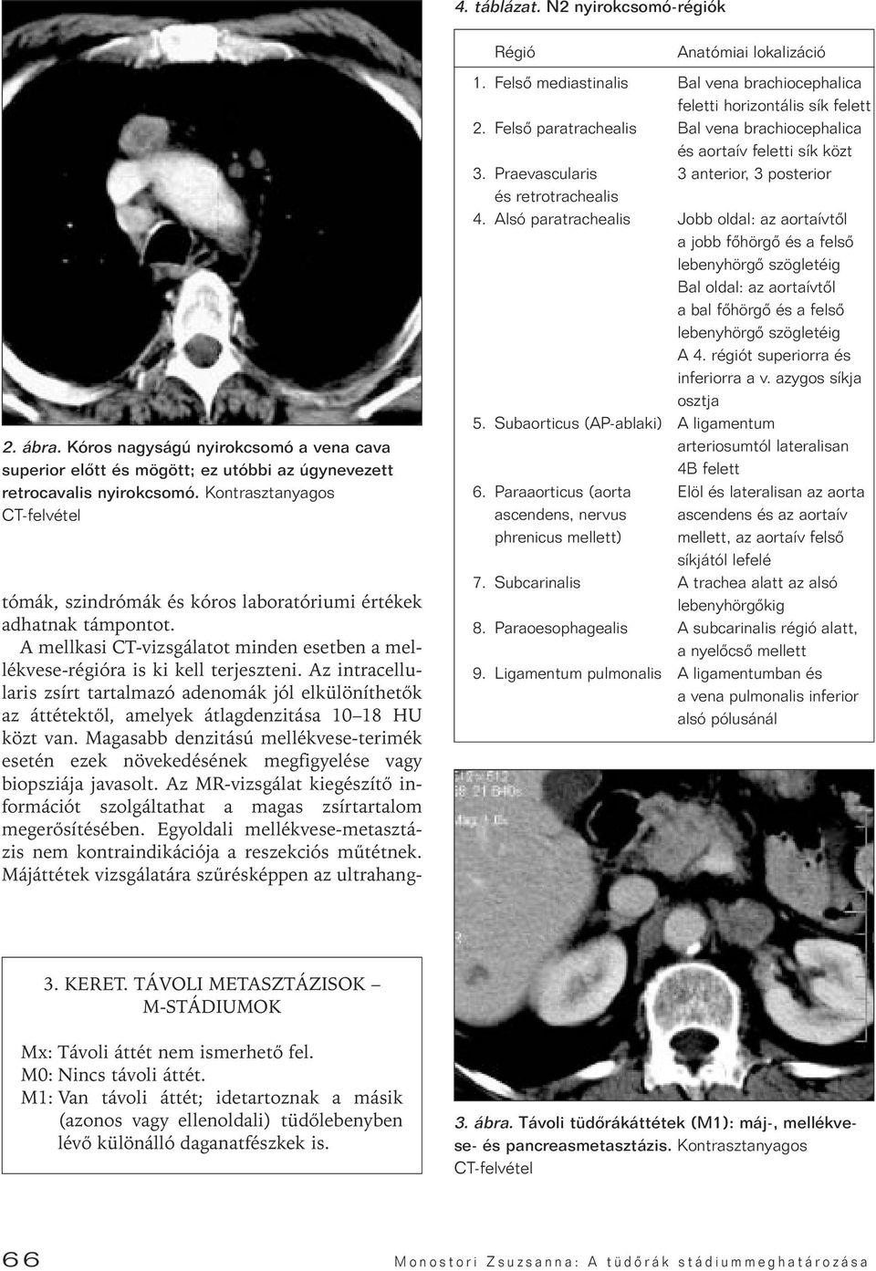 Az intracellularis zsírt tartalmazó adenomák jól elkülöníthetôk az áttétektôl, amelyek átlagdenzitása 10 18 HU közt van.