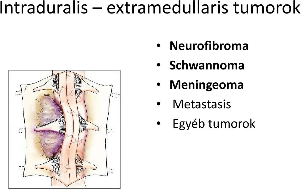 Neurofibroma Schwannoma