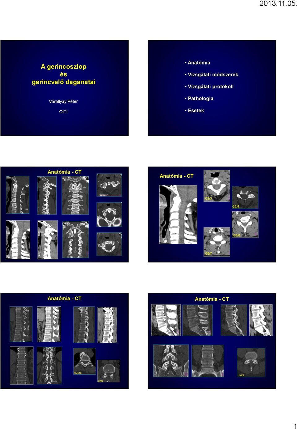Pathologia Esetek Anatómia - CT Anatómia - CT C2/3 C3/4