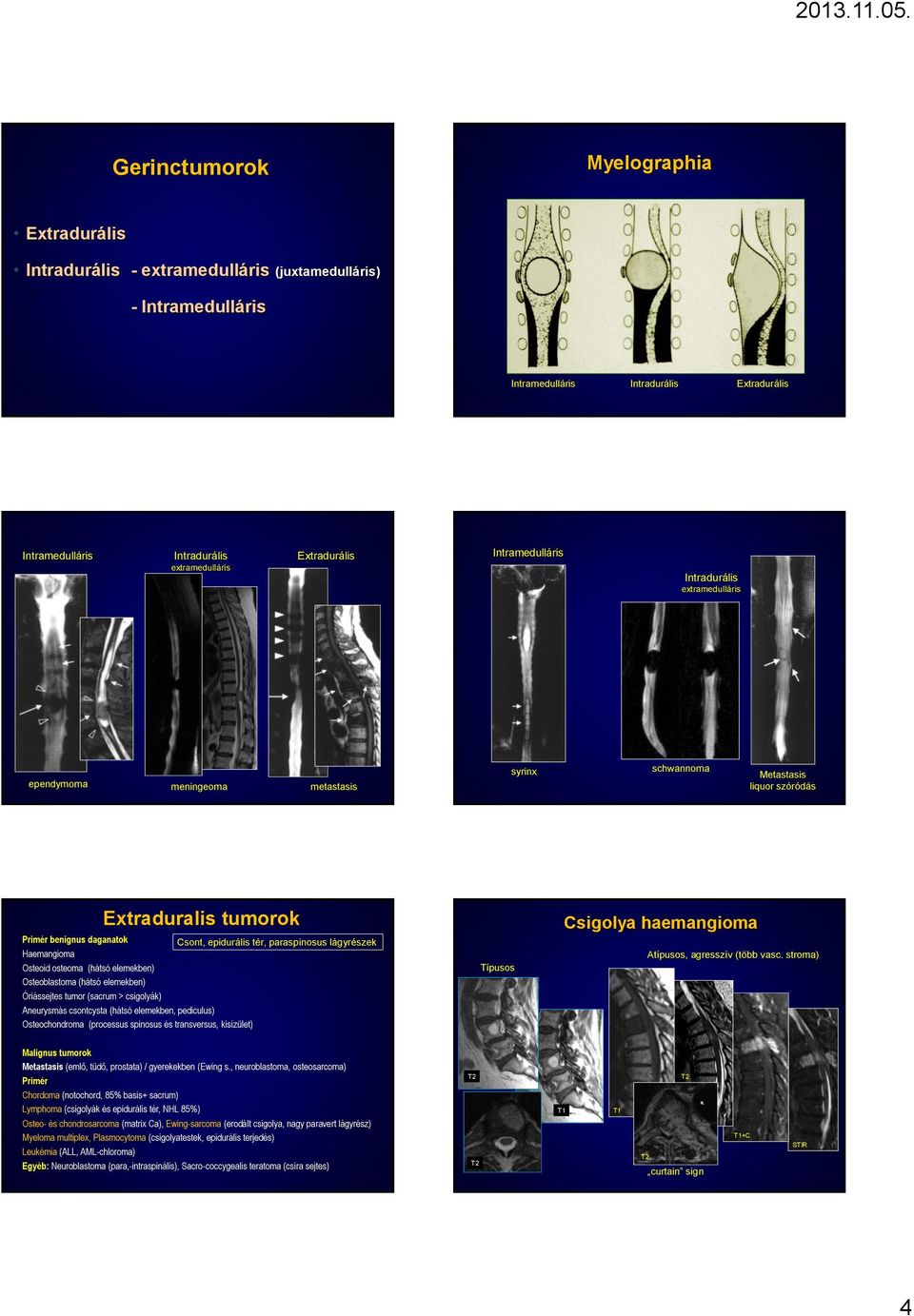 epidurális tér, paraspinosus lágyrészek Haemangioma Osteoid osteoma (hátsó elemekben) Osteoblastoma (hátsó elemekben) Óriássejtes tumor (sacrum > csigolyák) Aneurysmás csontcysta (hátsó elemekben,