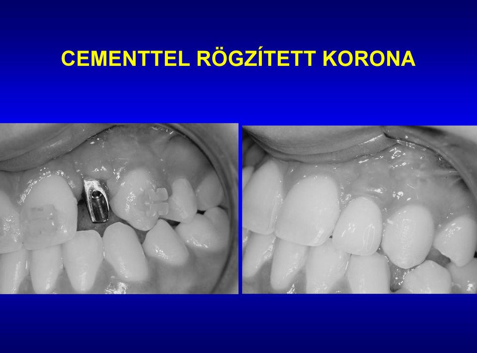 KORONA