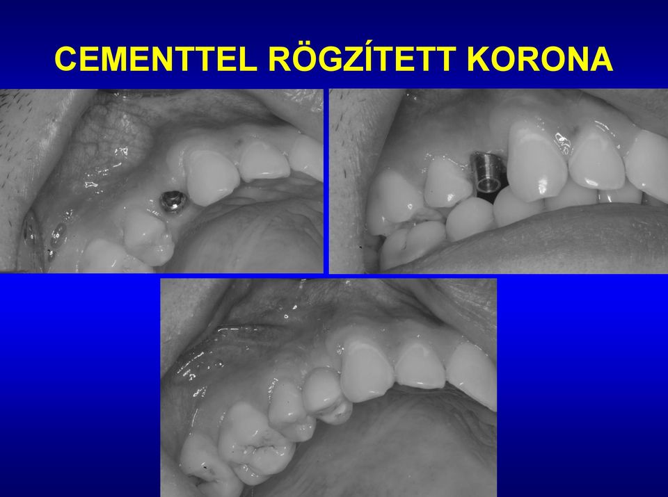 KORONA