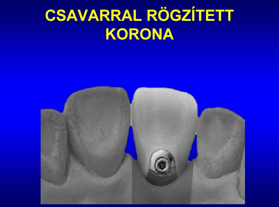 KORONA