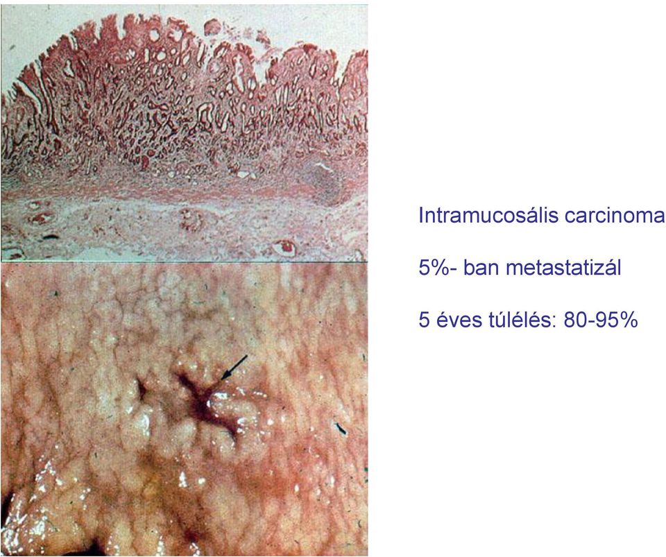 ban metastatizál