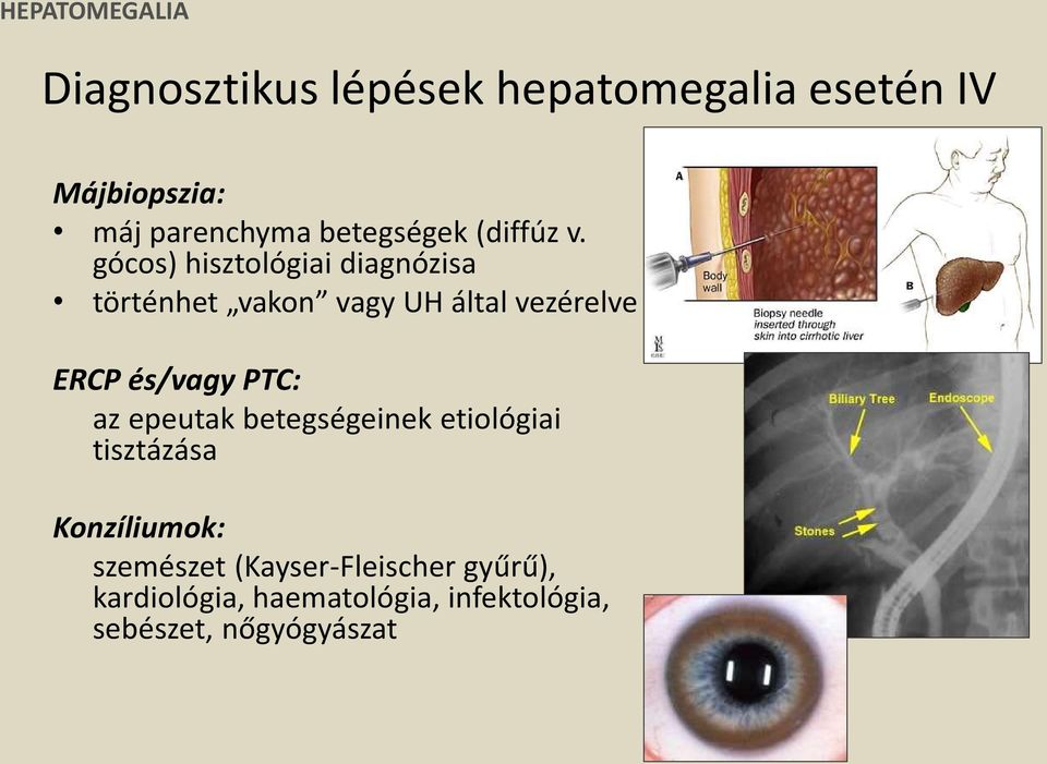 gócos) hisztológiai diagnózisa történhet vakon vagy UH által vezérelve ERCP és/vagy PTC: