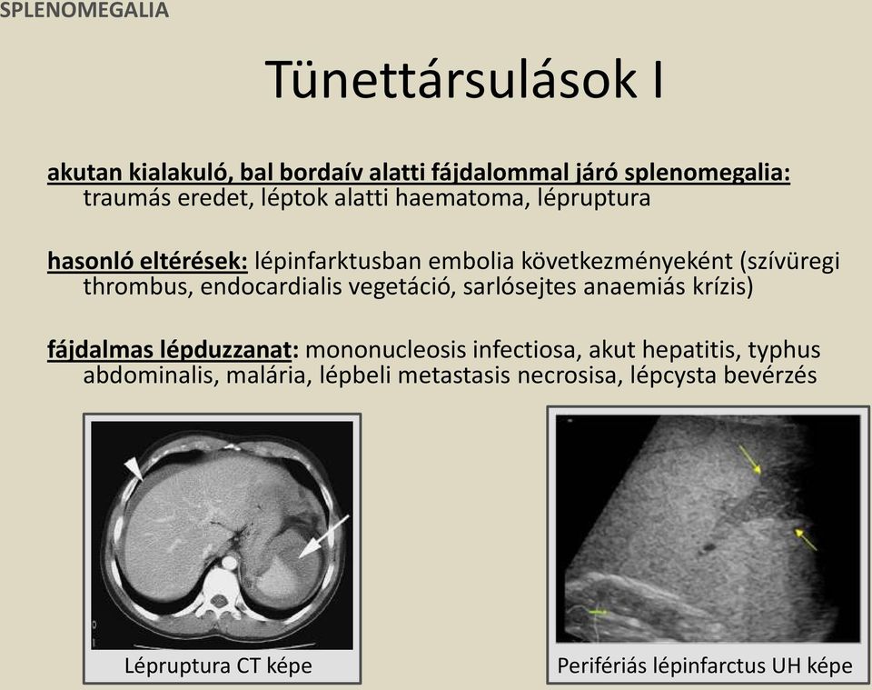 endocardialis vegetáció, sarlósejtes anaemiás krízis) fájdalmas lépduzzanat: mononucleosis infectiosa, akut hepatitis,