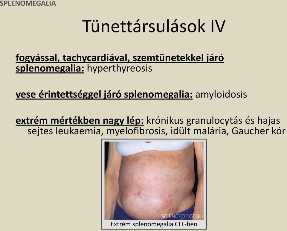 amyloidosis extrém mértékben nagy lép: krónikus granulocytás és hajas sejtes