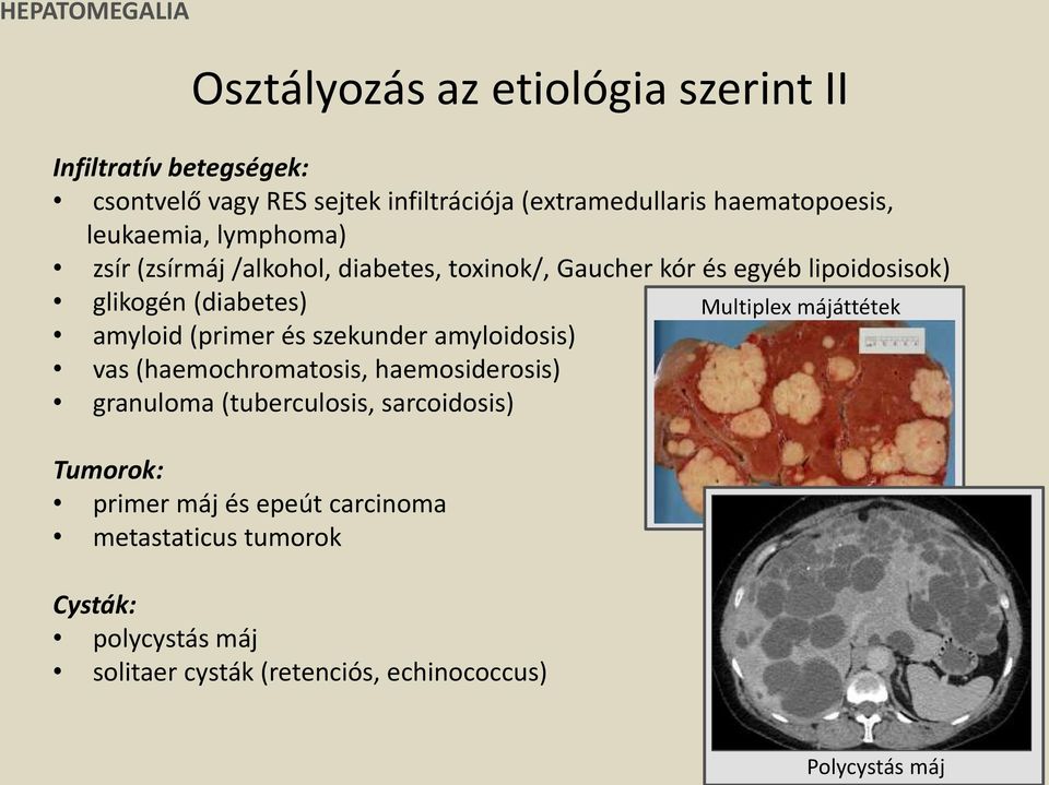 Multiplex májáttétek amyloid (primer és szekunder amyloidosis) vas (haemochromatosis, haemosiderosis) granuloma (tuberculosis,