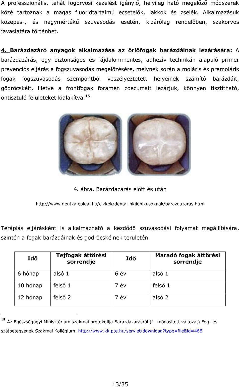 Barázdazáró anyagok alkalmazása az őrlőfogak barázdáinak lezárására: A barázdazárás, egy biztonságos és fájdalommentes, adhezív technikán alapuló primer prevenciós eljárás a fogszuvasodás