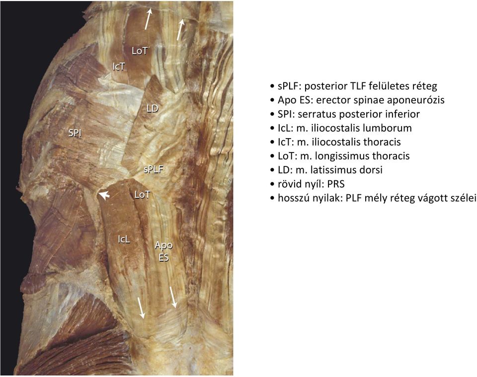 iliocostalis lumborum IcT: m. iliocostalis thoracis LoT: m.