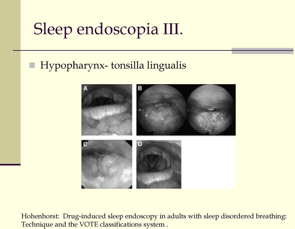 Drug-induced sleep endoscopy in adults with