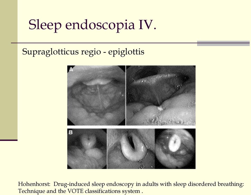 Drug-induced sleep endoscopy in adults with