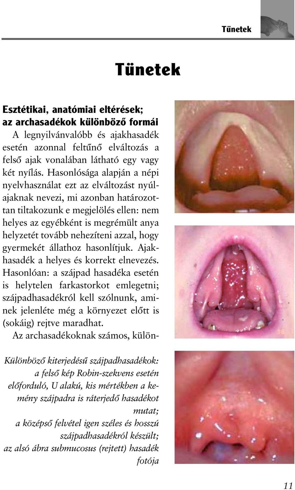 Hasonlósága alapján a népi nyelvhasználat ezt az elváltozást nyúlajaknak nevezi, mi azonban határozottan tiltakozunk e megjelölés ellen: nem helyes az egyébként is megrémült anya helyzetét tovább