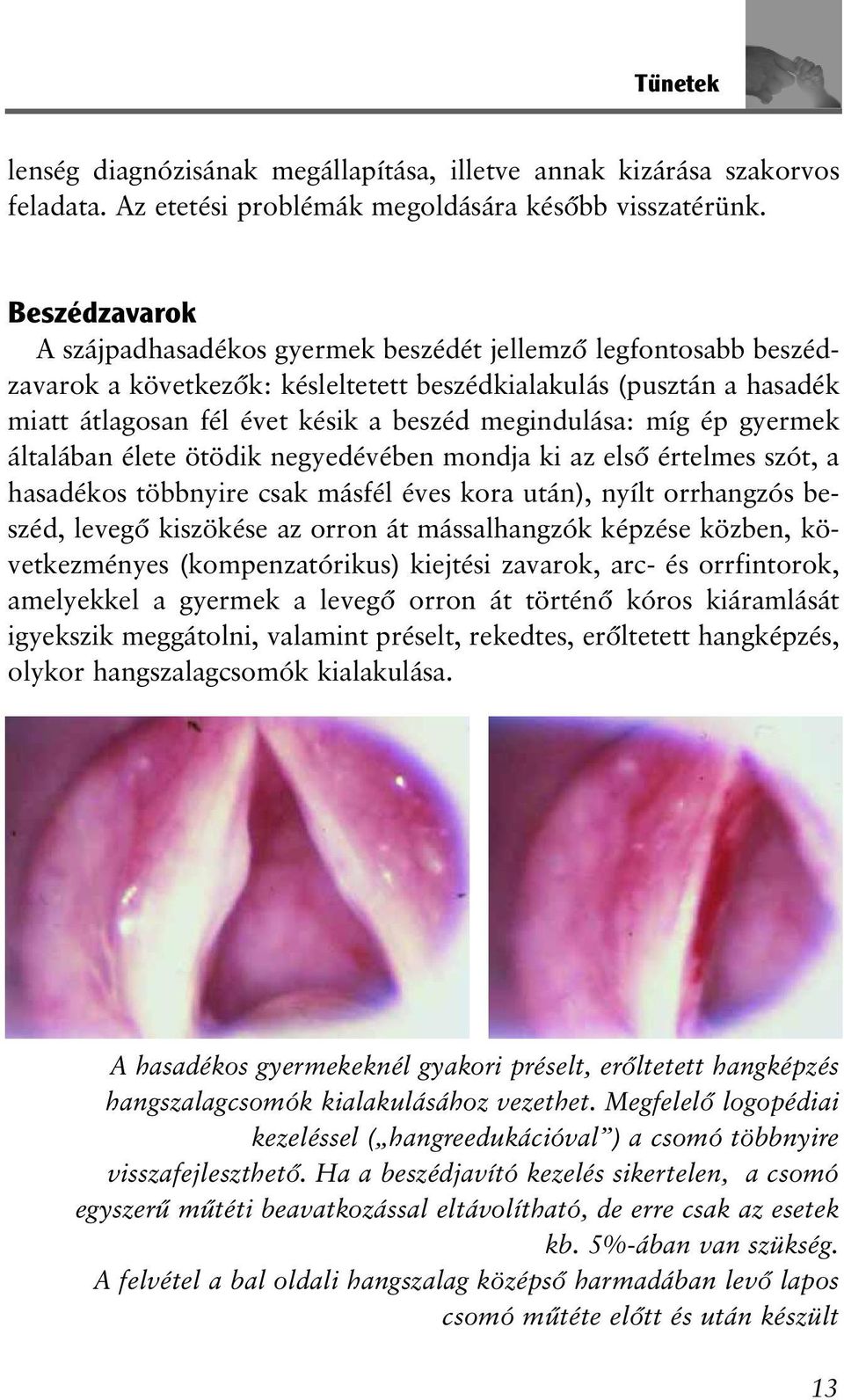 megindulása: míg ép gyermek általában élete ötödik negyedévében mondja ki az elsõ értelmes szót, a hasadékos többnyire csak másfél éves kora után), nyílt orrhangzós beszéd, levegõ kiszökése az orron