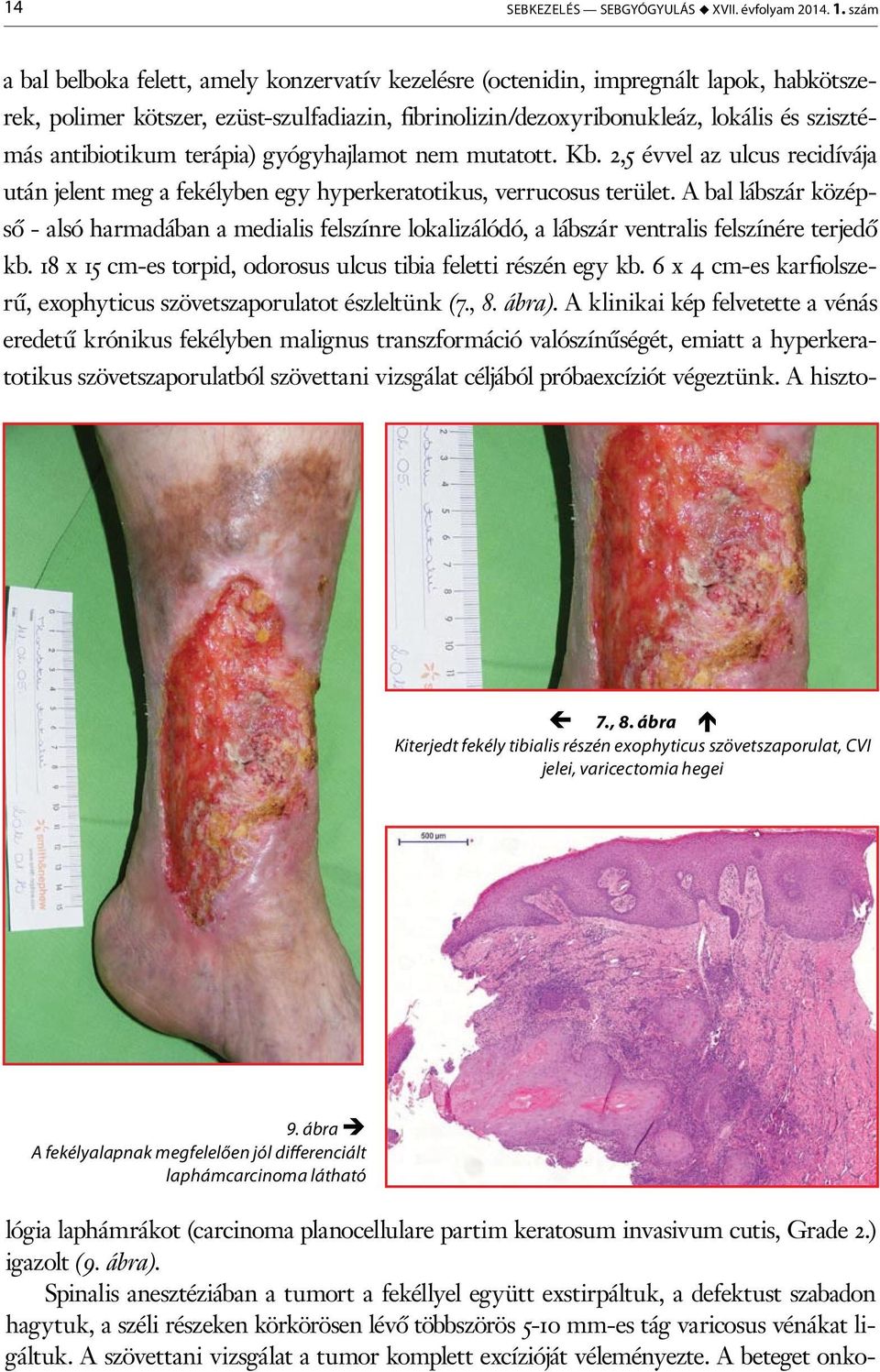 antibiotikum terápia) gyógyhajlamot nem mutatott. Kb. 2,5 évvel az ulcus recidívája után jelent meg a fekélyben egy hyperkeratotikus, verrucosus terület.