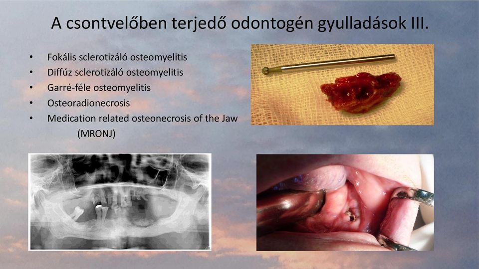 sclerotizáló osteomyelitis Garré-féle osteomyelitis