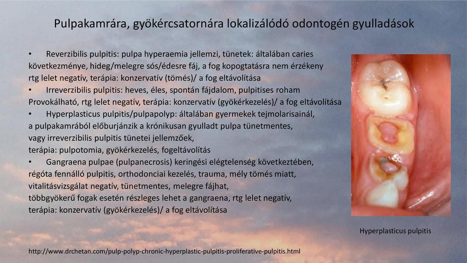 terápia: konzervatív (gyökérkezelés)/ a fog eltávolítása Hyperplasticus pulpitis/pulpapolyp: általában gyermekek tejmolarisainál, a pulpakamrából előburjánzik a krónikusan gyulladt pulpa tünetmentes,